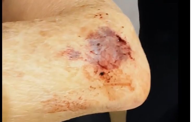 Denúncia de mau atendimento de hospital de Maringá aos servidores públicos 1 machucado Denúncia de mau atendimento de hospital de Maringá aos servidores públicos